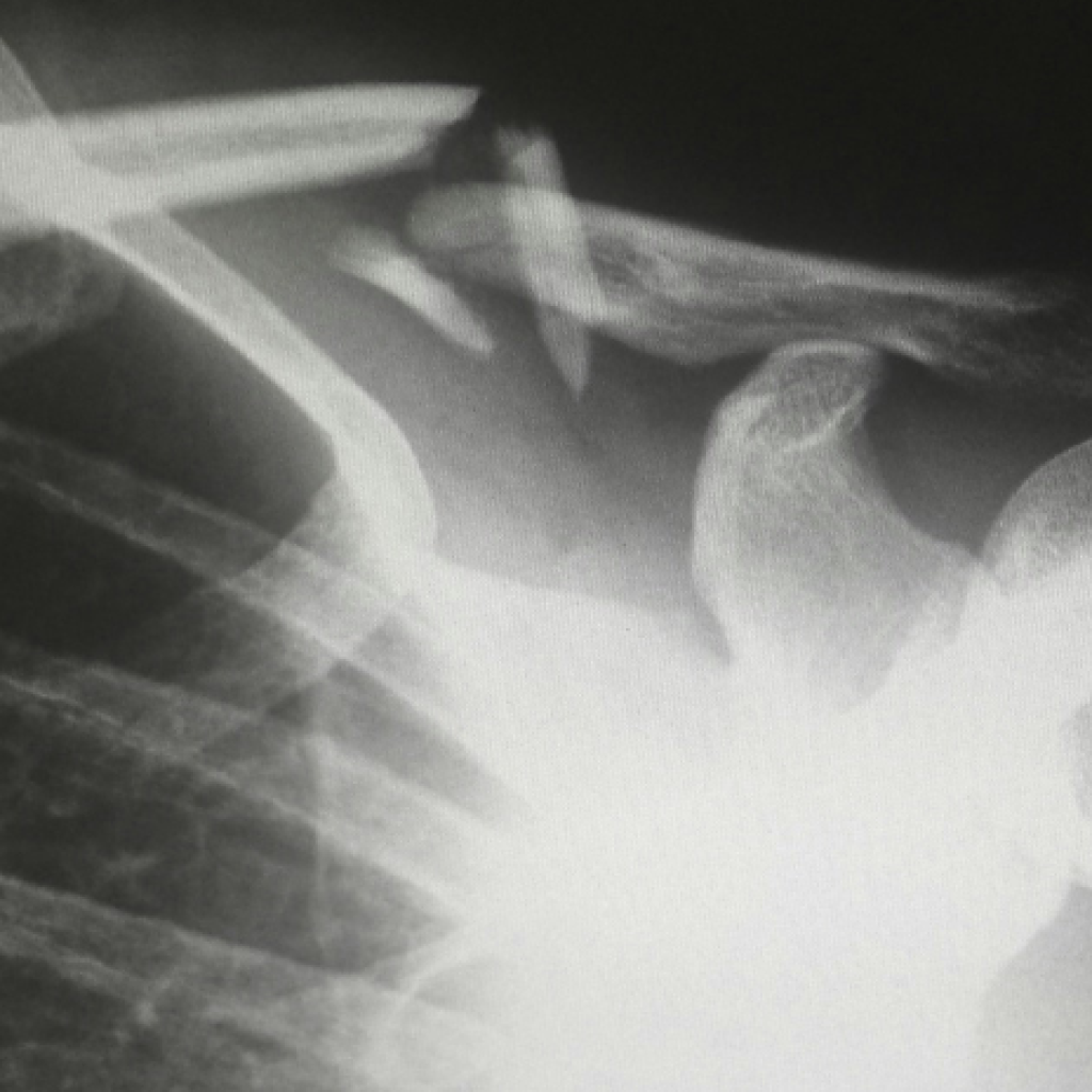 An x-ray of a broken collar bone