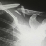 An x-ray of a broken collar bone
